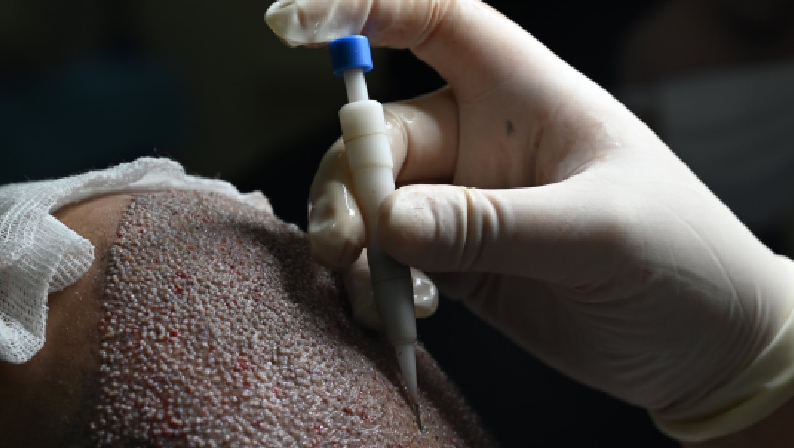 Hair transplant and hair restoration treatment