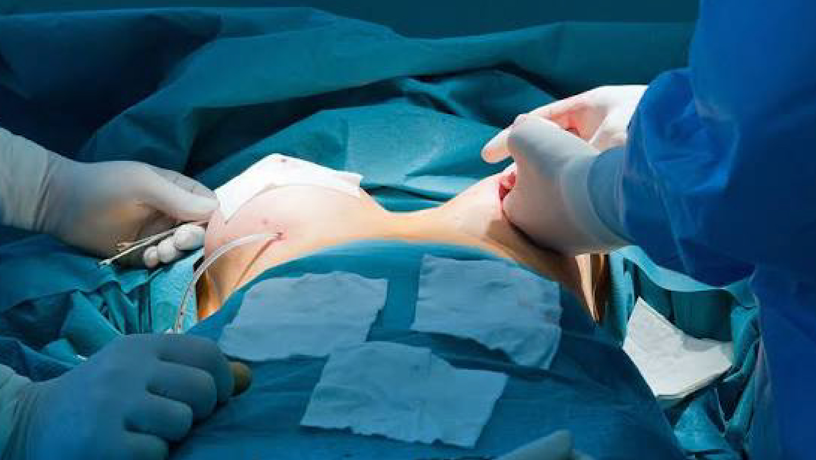 Breast aesthetic surgery consultation