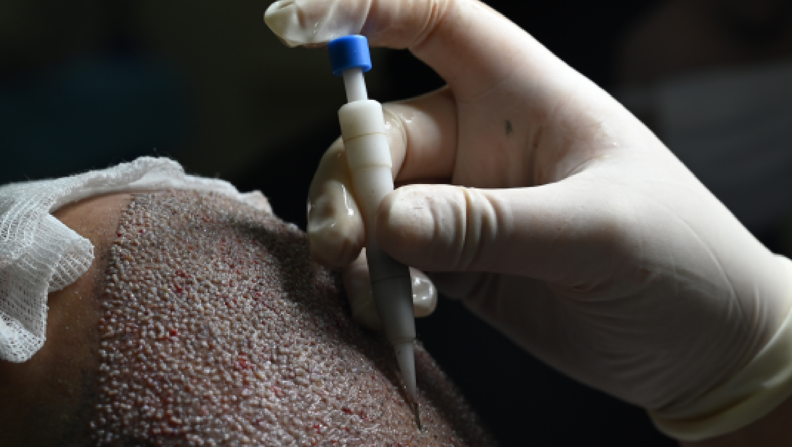 Hair transplant and hair restoration treatment