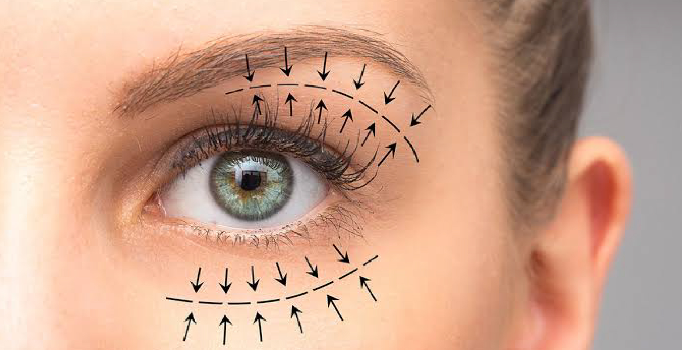 Blepharoplasty (Eyelids)