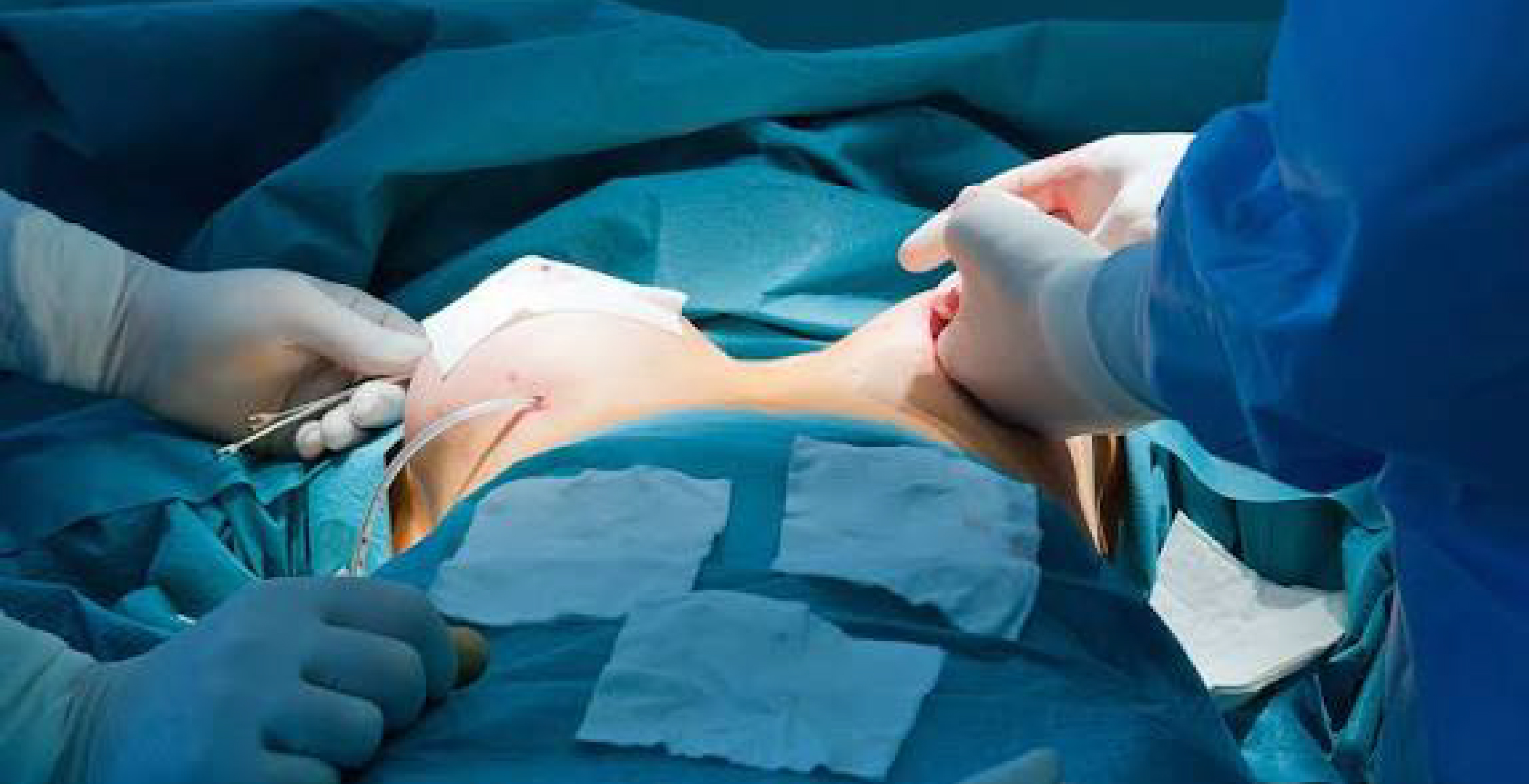Breast Lift