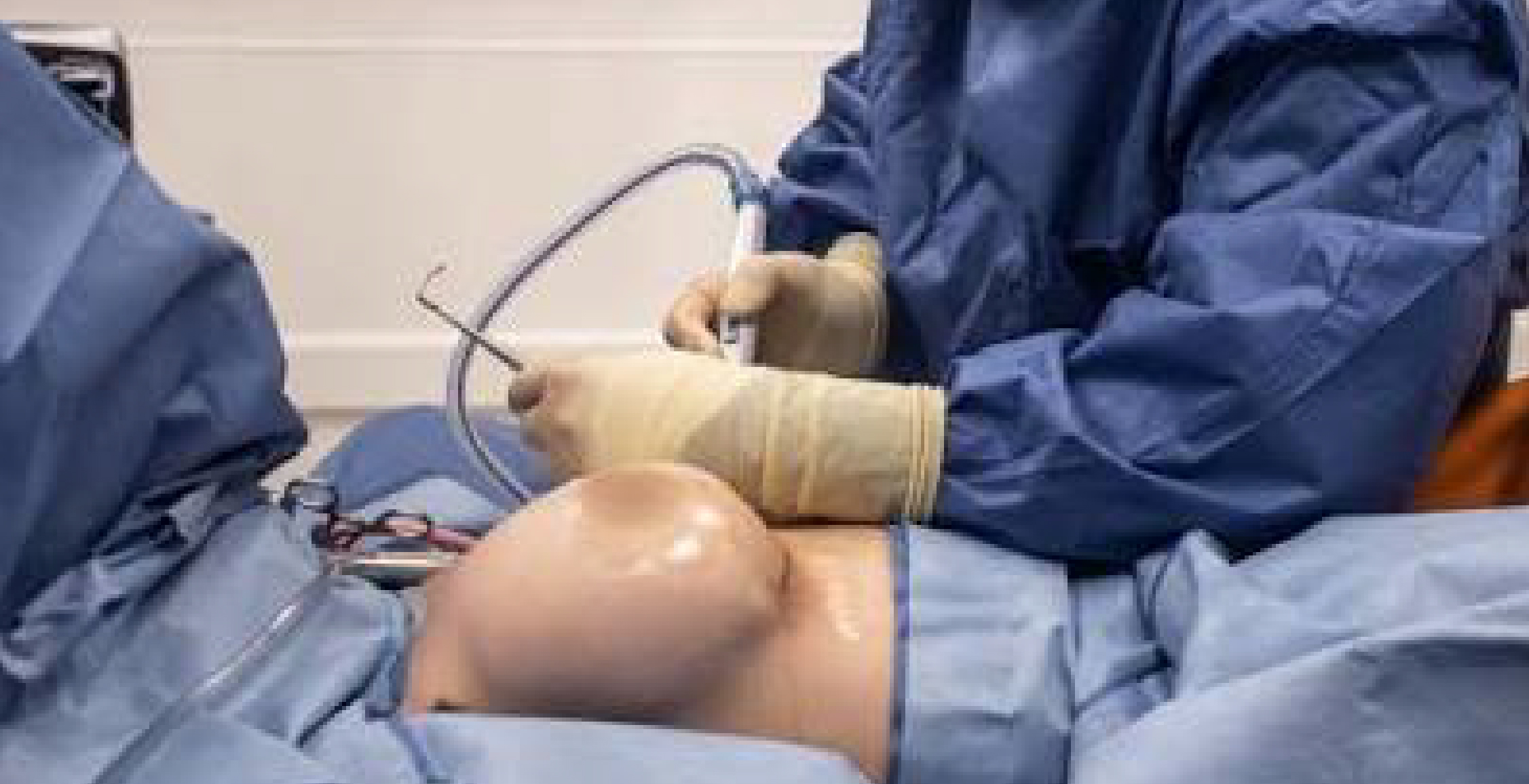 Breast Reconstruction