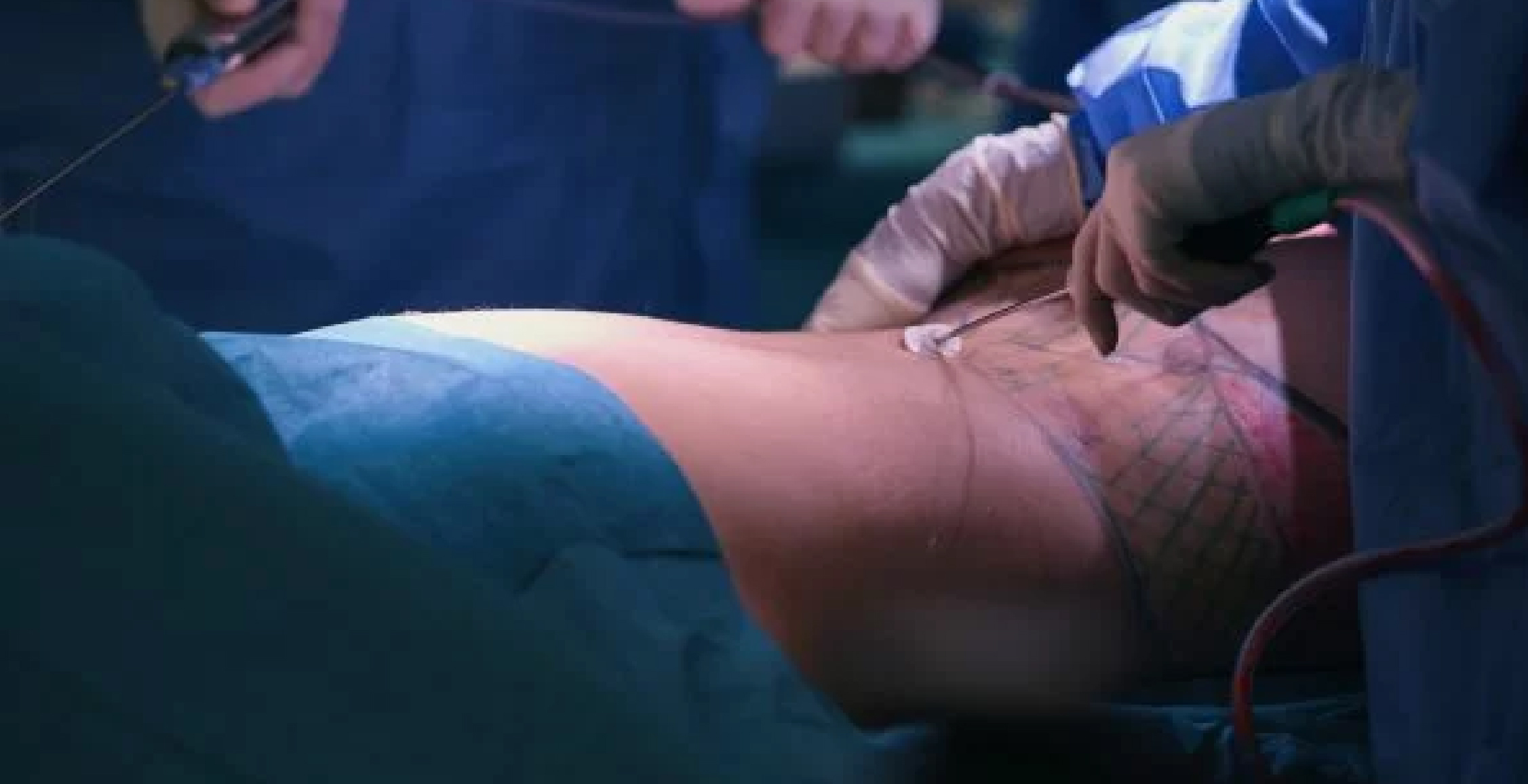 HD Liposuction