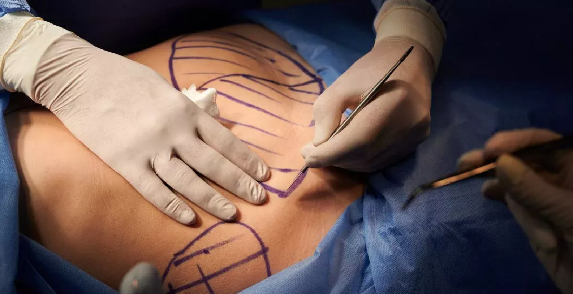 Abdominoplasty (Tummy Tuck)