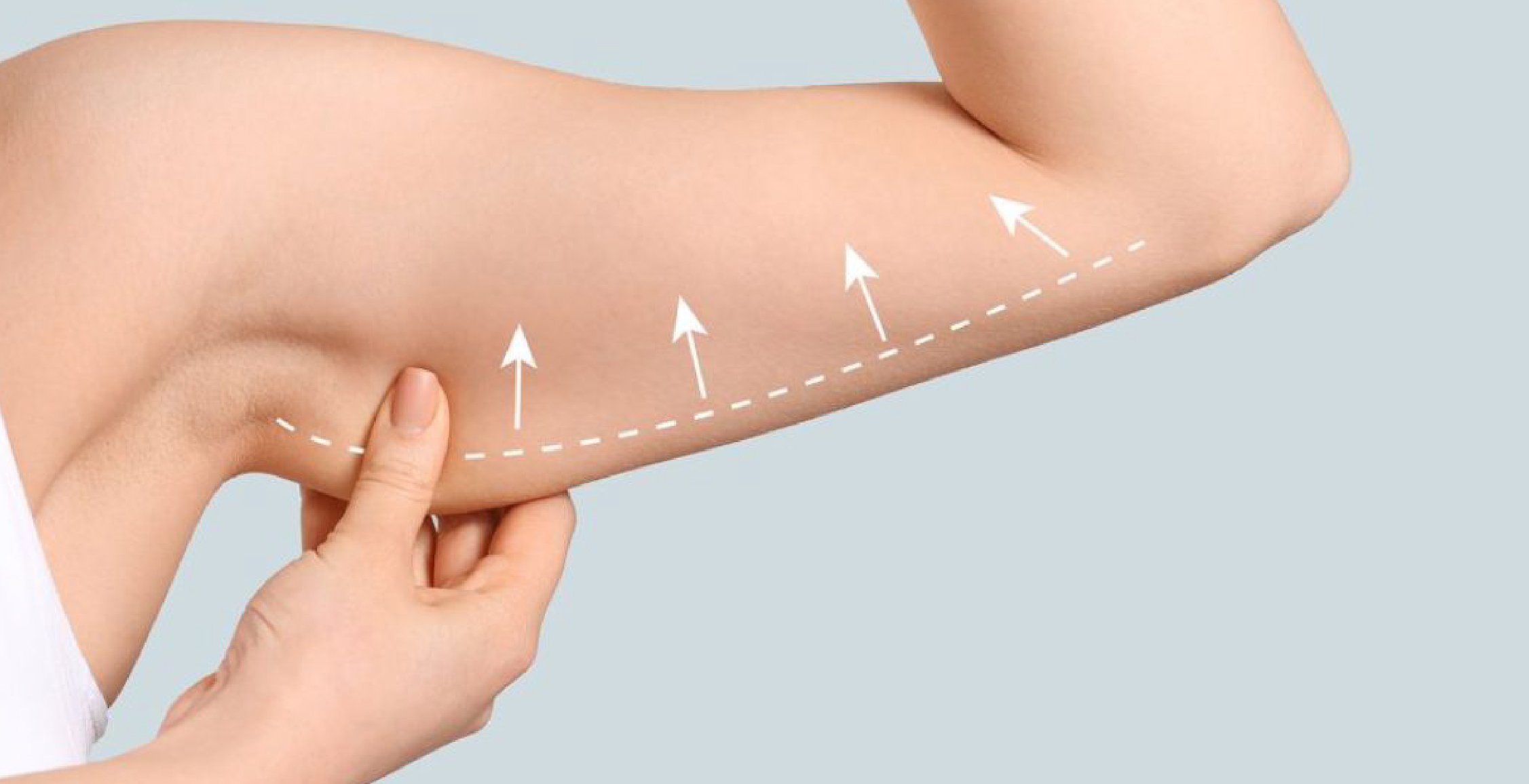 Arm Lift (Brachioplasty)
