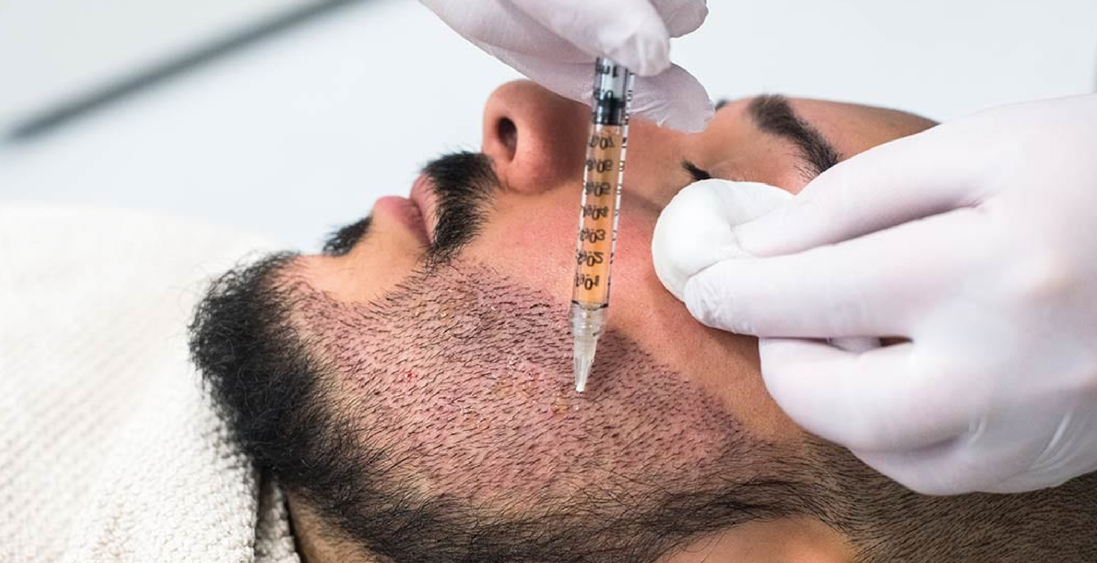 Beard Transplant