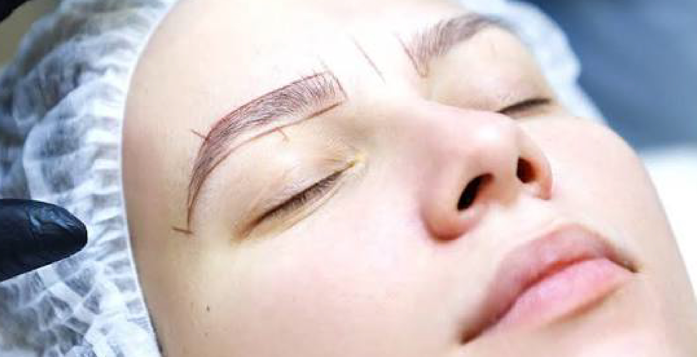 Eyebrow Transplant