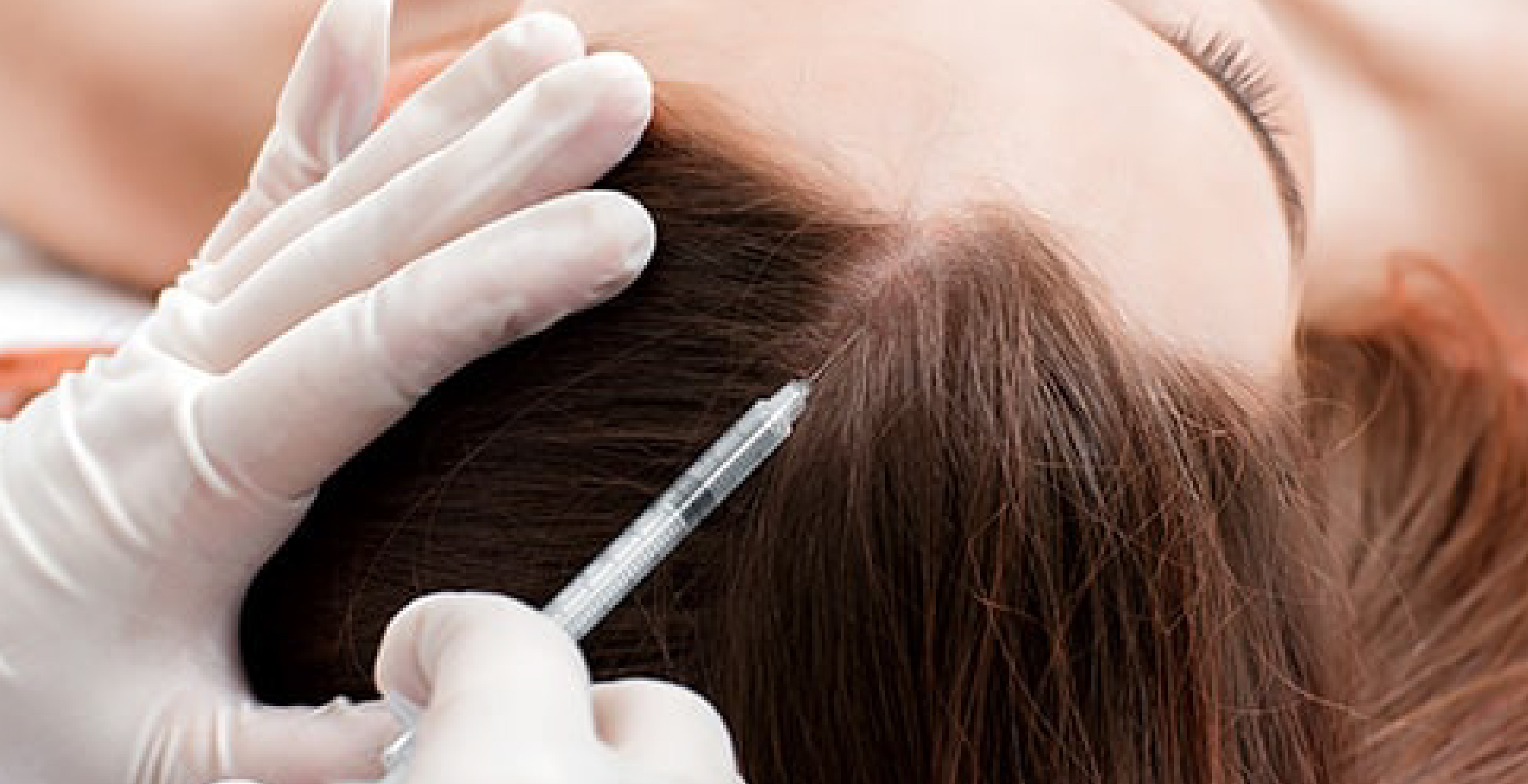 Hair Mesotherapy