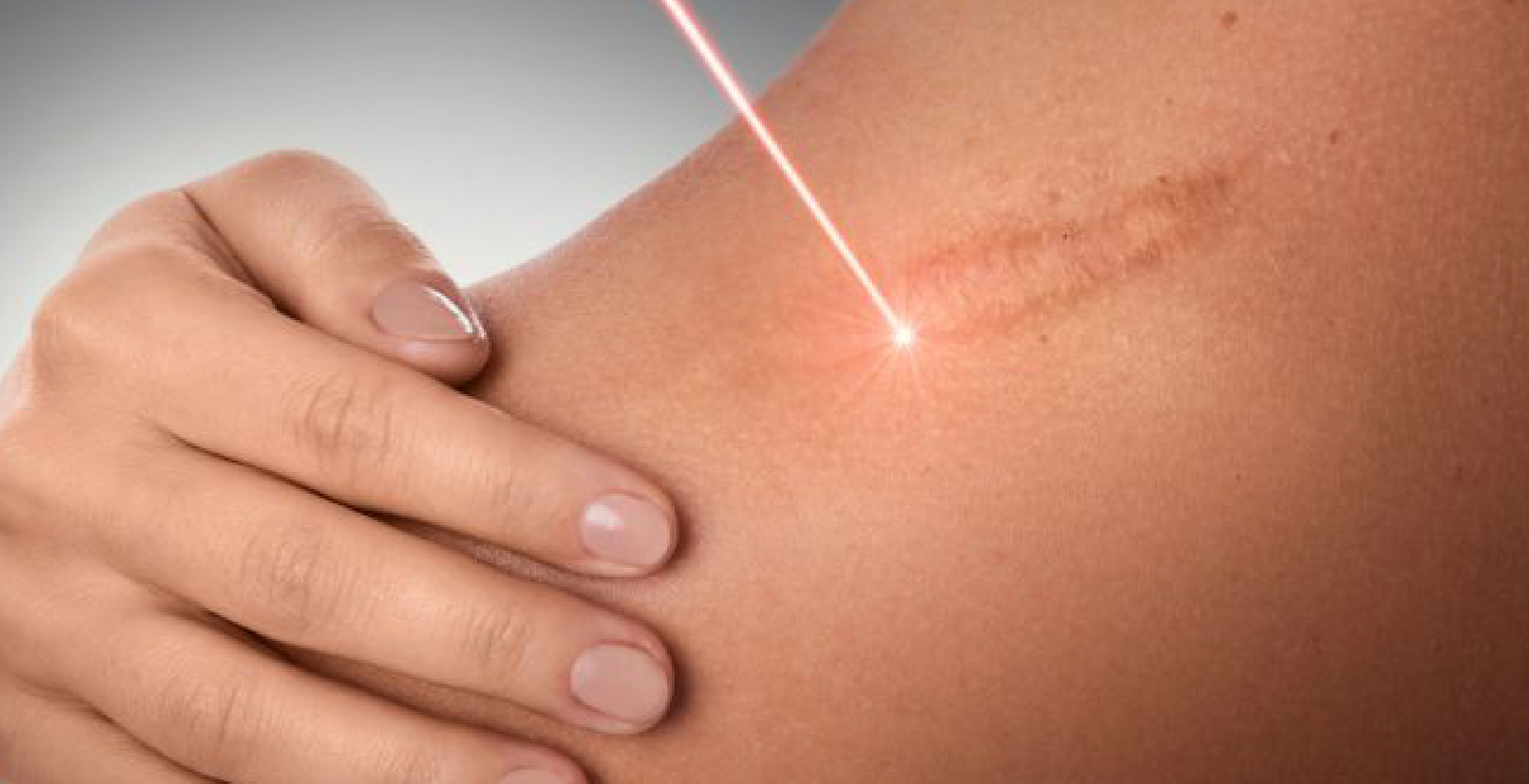 Scar Treatment
