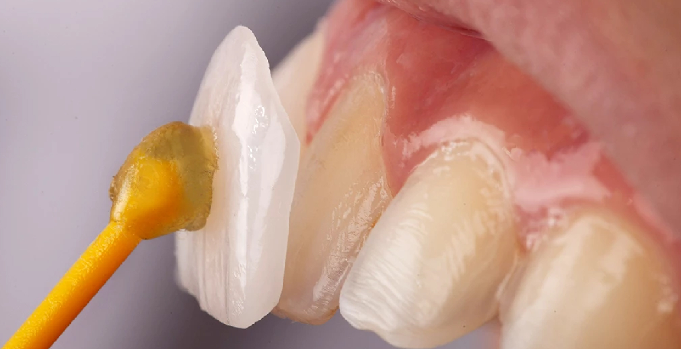 Dental Veneers