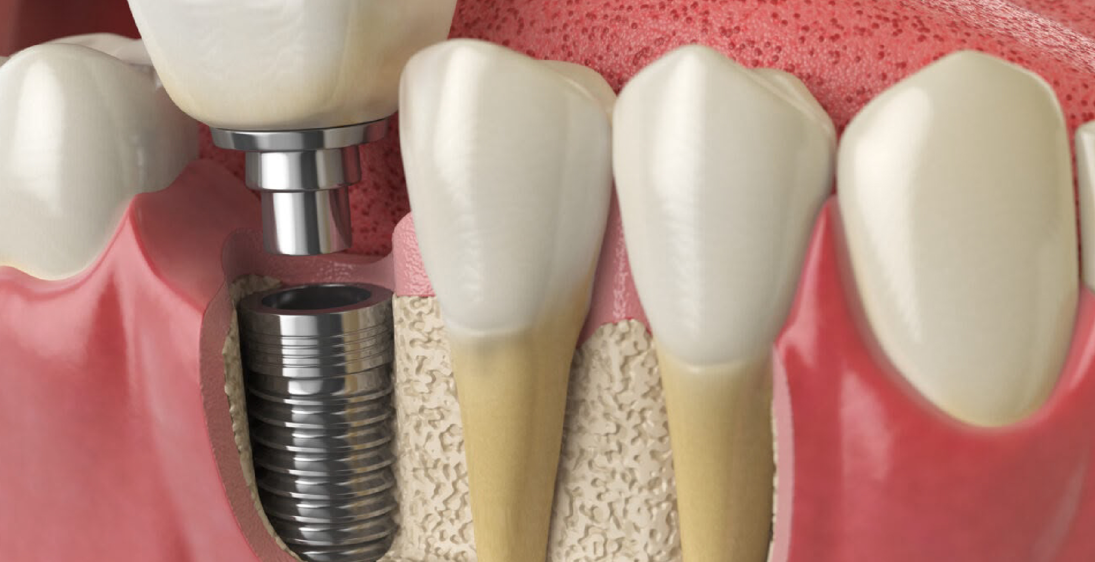 Dental Implants