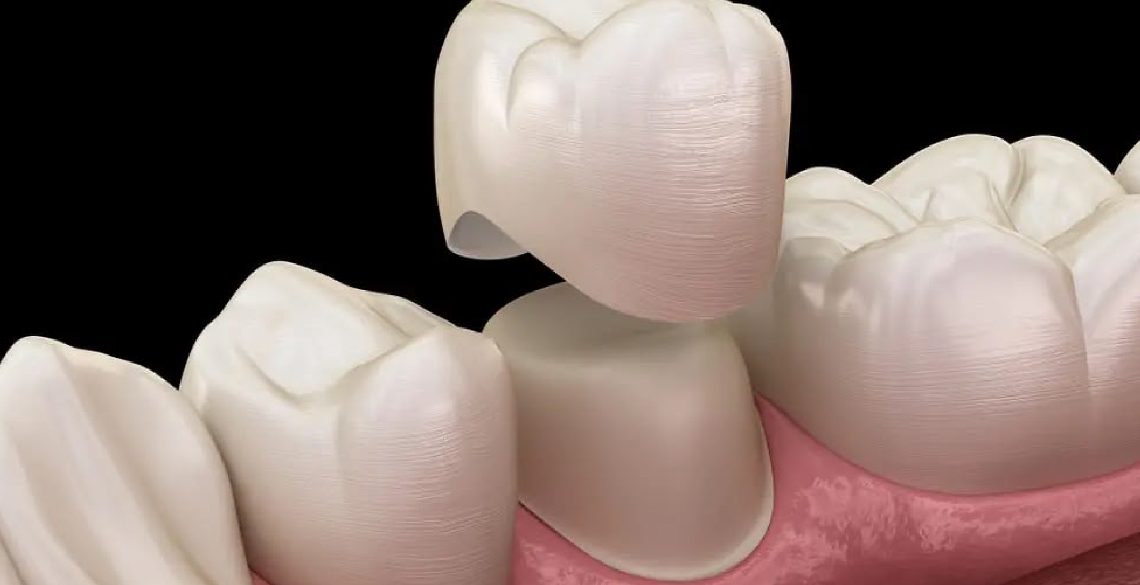 Dental Crowns