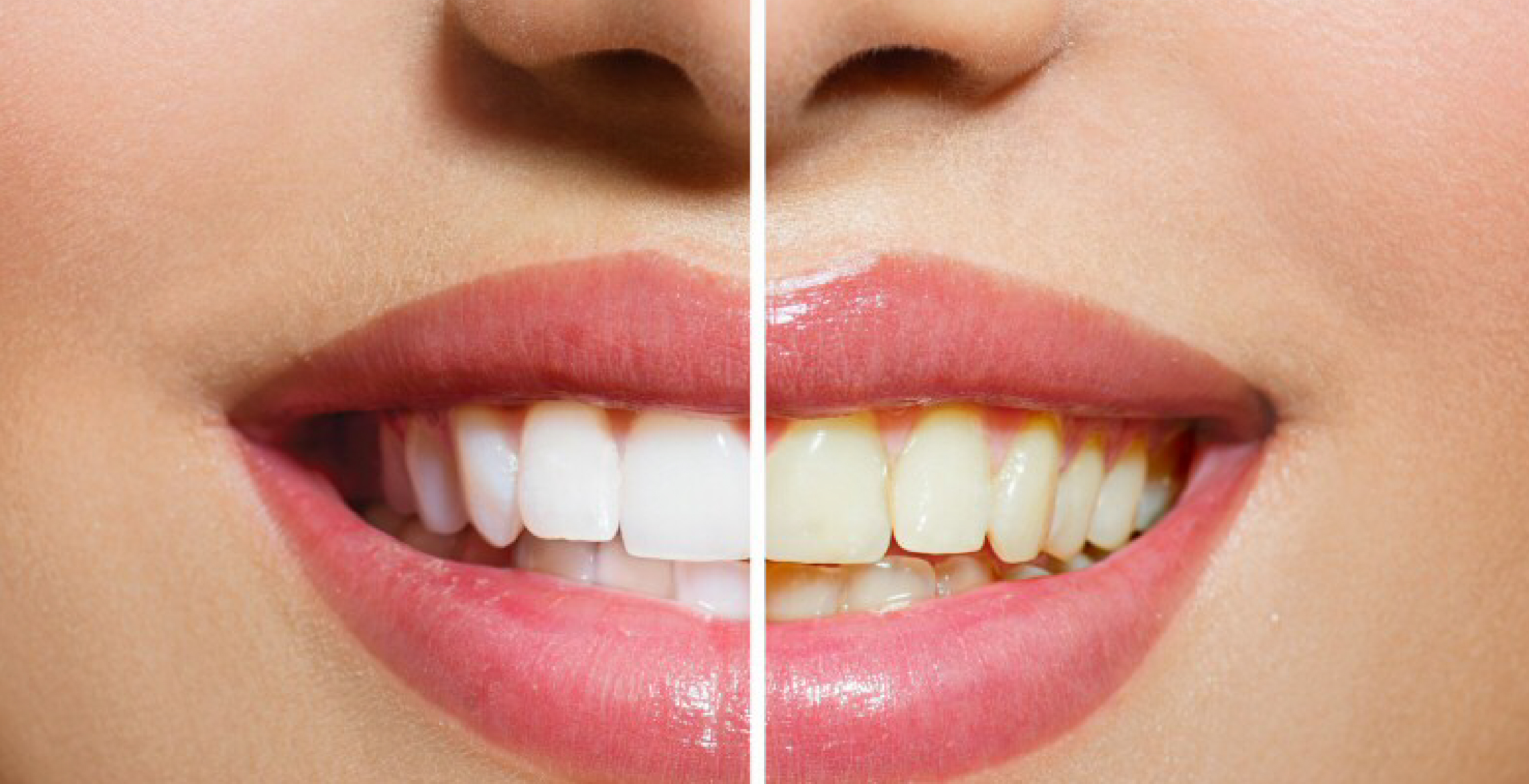 Teeth Whitening