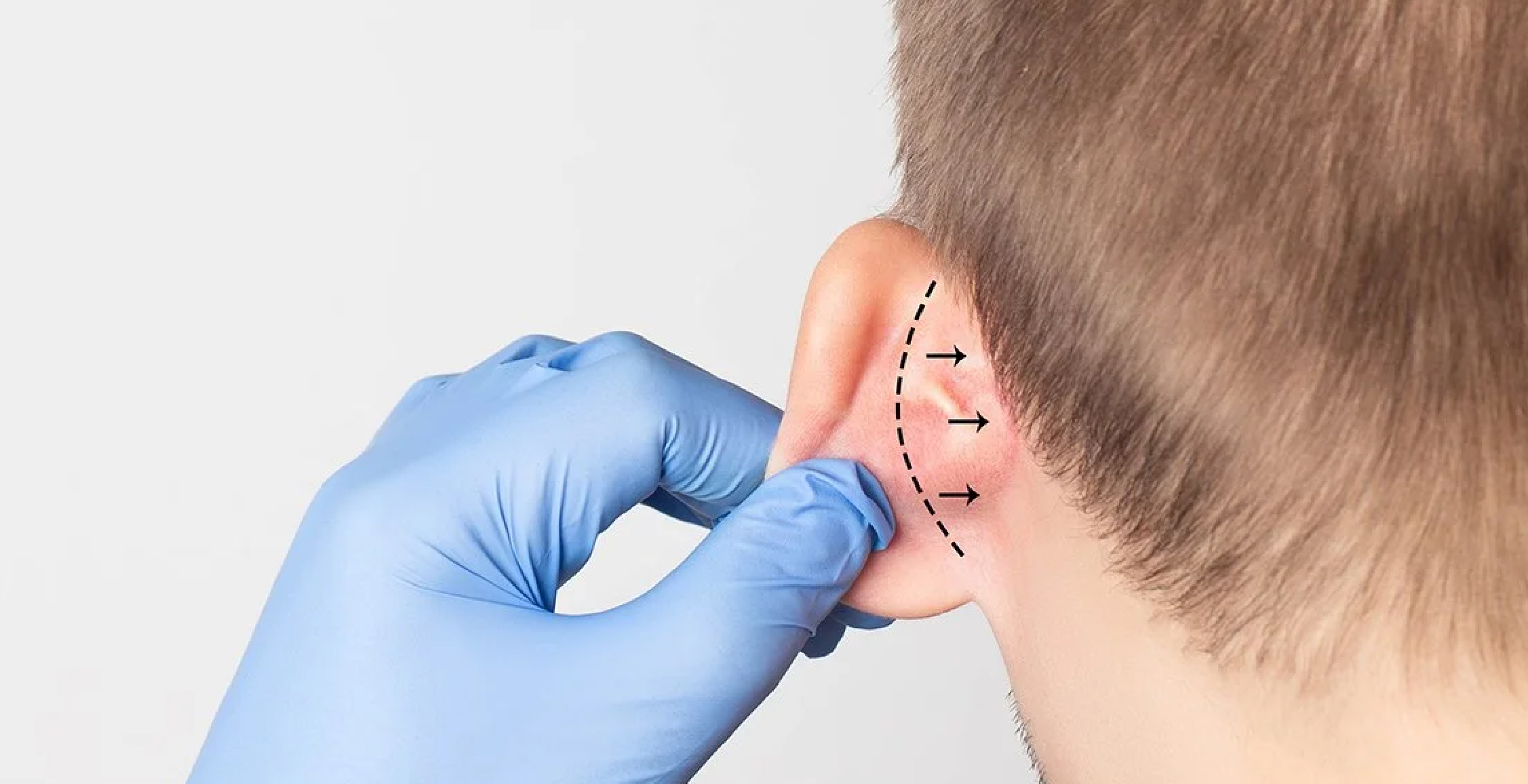 Otoplasty (Prominent Ears)