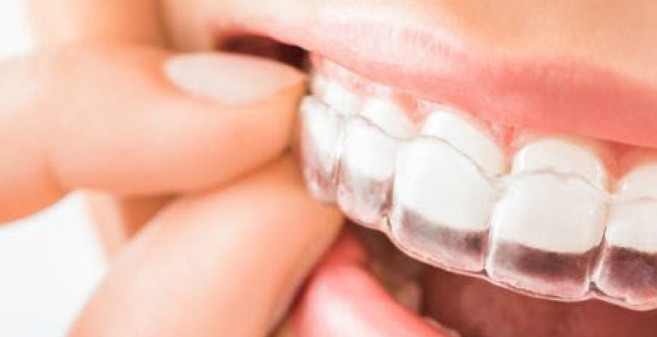Invisible Orthodontics