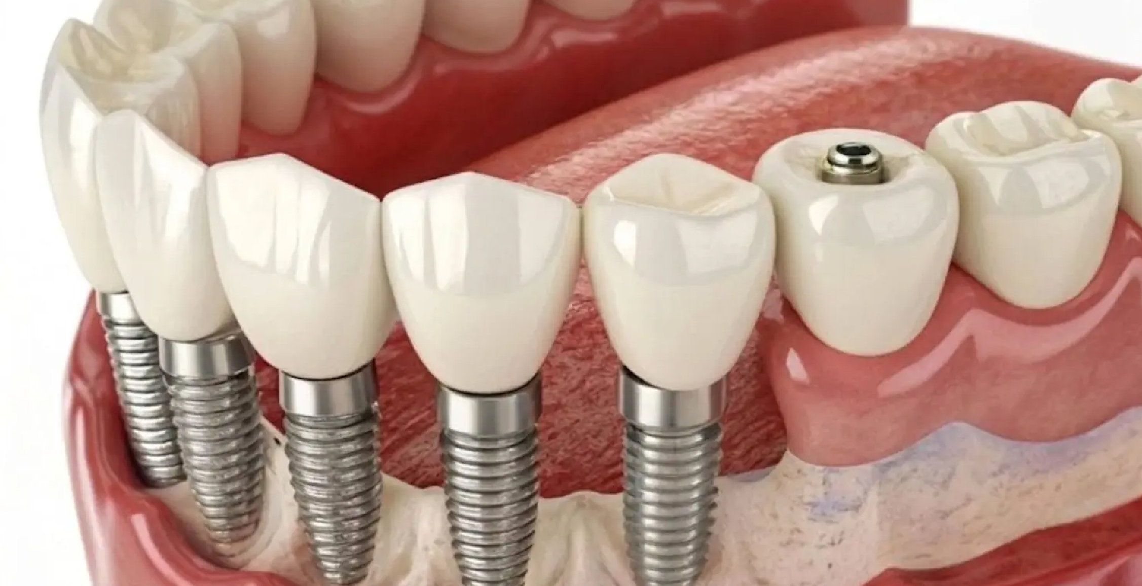 Full Mouth Rehabilitation