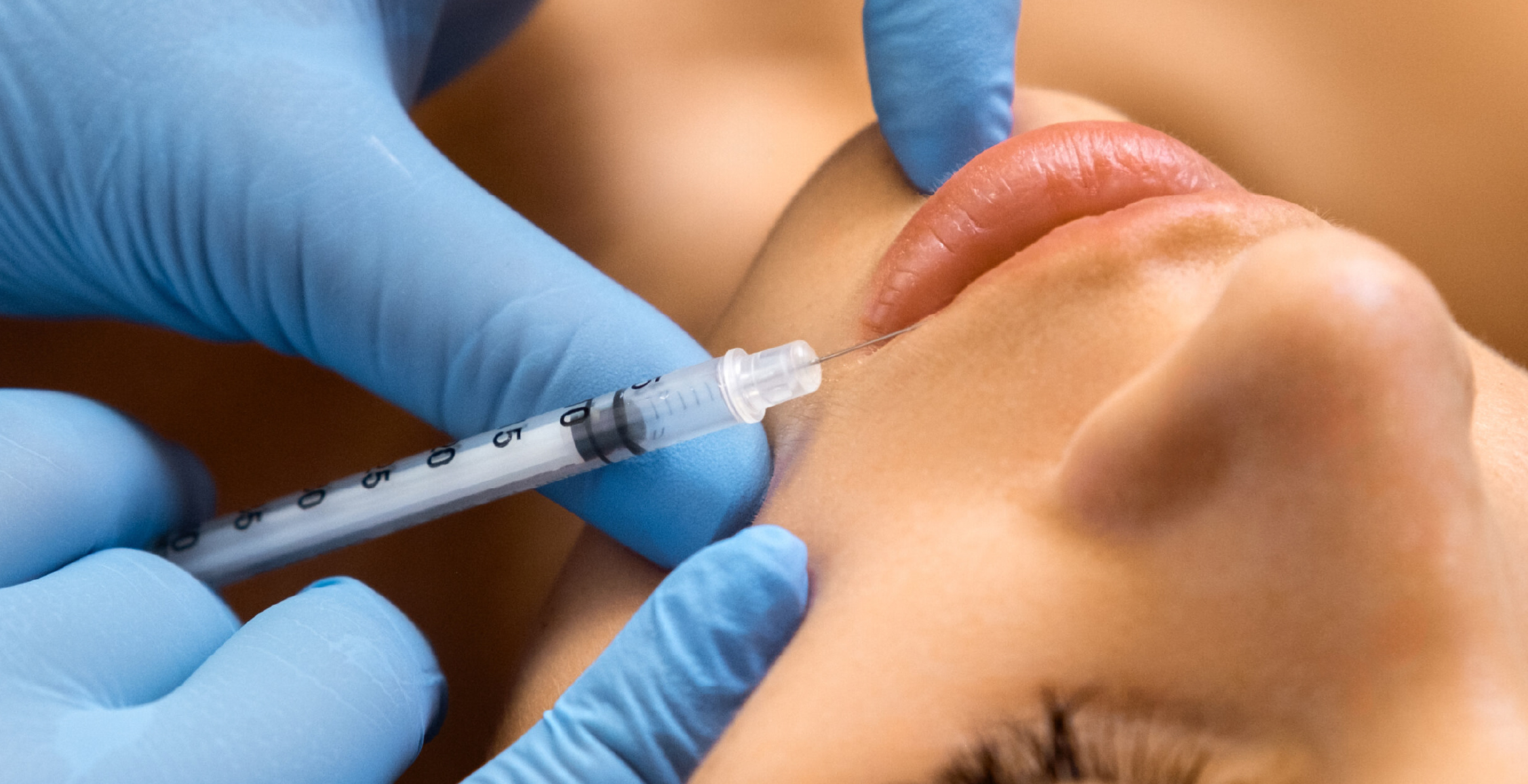 Lip Lift